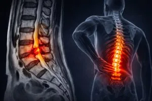 resonancia columna lumbar hernia disco nervio compresion