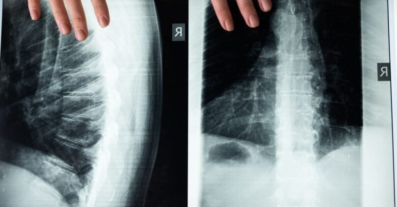 dolor lumbar al caminar